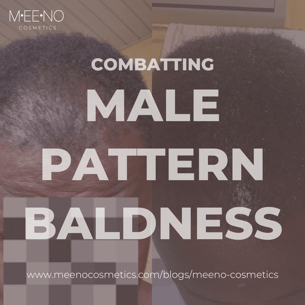 Combatting Male Pattern Baldness